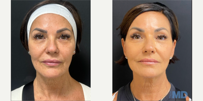 45-54 year old woman treated with NeoGen Plasma, Skin Rejuvenation - 90 days post, this lovely patient is enjoying her NeoGen results.