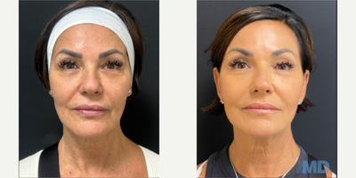 45-54 year old woman treated with NeoGen Plasma, Skin Tightening, Skin Rejuvenation - 90 days post, this lovely patient is enjoying her NeoGen results.