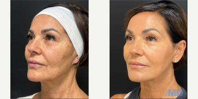 45-54 year old woman treated with NeoGen Plasma, Skin Rejuvenation - 90 days post, this lovely patient is enjoying her NeoGen results.