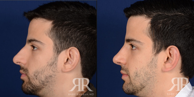 35-44 year old man treated with Septoplasty, Rhinoplasty - Male Septoplasty & Rhinoplasty