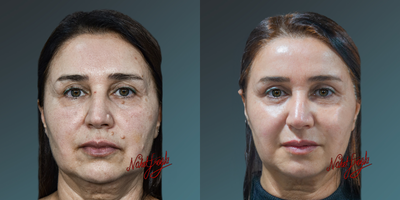 35-44 year old woman treated with PicoSure - 35-44 year old woman treated with PicoSure