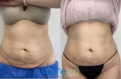 Woman treated with Skintyte - Woman treated with Skintyte