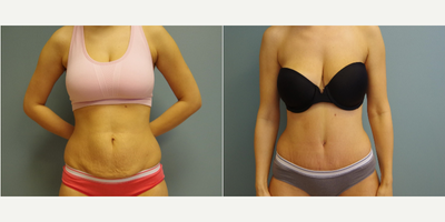 25-34 year old woman treated with Tummy Tuck, Smart Lipo - Patient is 6 weeks post op from a tummy tuck with liposuction to the abdomen