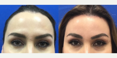 Transgender woman treated with Forehead Reduction - Transgender woman treated with Forehead Reduction