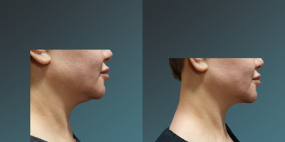 35-44 year old woman treated with Thermage FLX - 35-44 year old woman treated with Thermage FLX