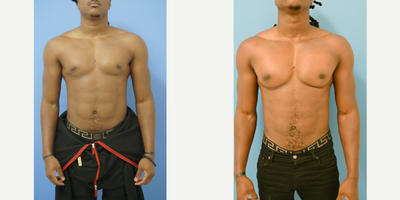 25-34 year old man treated with Pec Implants - 31 year old male from Georgia 2 years after replacing his original pectoral implants for larger custom implants performed by Dr Sam Gershenbaum. He replaced his submuscular vertical rectangular soft solid silicone implants with 1.6cm of projection for larger custom extended implants with about 2.1cm of projection and some upper lateral extension of the implant. He looks even more well built, yet natural, and is very pleased with his results.