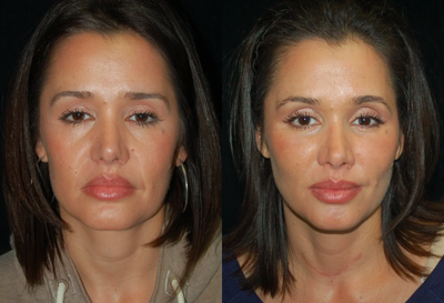 Facial Fat Grafting - 36 year old female that underwent facial fat grafting