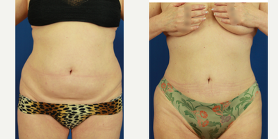55-64 year old woman treated with Power-Assisted Liposuction (PAL) and Renuvion skin tightening - Patient underwent 360 liposuction and renuvion skin tightening