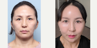 35-44 year old woman treated with Cheekbone Reduction - Cheekbone Reduction Subbrow Excision (Browlift)Malar Reduction Lower BlepharoplastyFat Grafting-Forehead-Temple