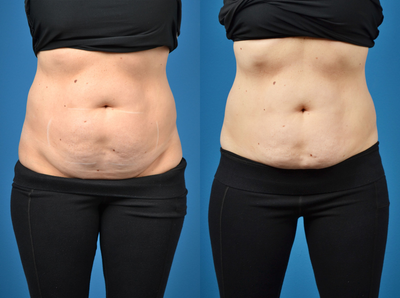 35-44 year old woman treated with SculpSure - SculpSure patient with treatment to abs and flanks