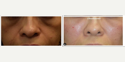 35-44 year old woman treated with Fillers & PRP for deep under eye hollow - Filler + PRP Injections for Underye Hollow