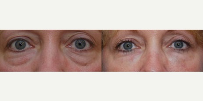 Woman treated with Restylane - Injectable Fillers to under eyes
