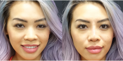 25-34 year old woman treated with Restylane for her Rhinoplasty - The patient had a non-surgical rhinoplasty. Restylane was used to improve the overall appearance of her nose. The filler was used to give the nose a narrower and more sleek appearance. It was also used to enhance her nasal tip and improve the contour of the nasal bridge. The filler is a great options as it can be done in the office in twenty minutes.