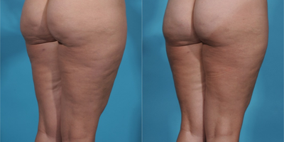 35-44 year old woman treated with Cellfina - Cellfina treatment to buttocks and thighs.