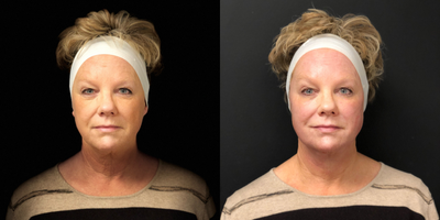63 year old female treated with Nova Threads - 63 year old female treated with Nova Threads