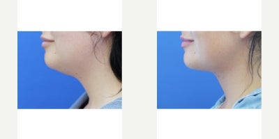 25-34 year old woman treated with Neck Lift - When the neck skin is elastic enough, platysmaplasty without skin resection becomes a great option because it avoids putting a scar around the ear. Younger patients tend to do well.