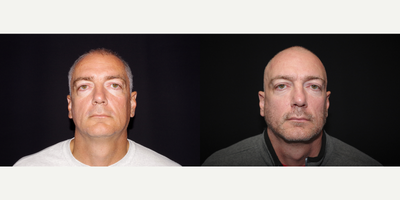 45-54 year old man treated with ArteFill - 49 year old male received 3 syringes of Bellafill to the cheeks and infraorbicular area; photos depict the patient's results 6 months post-treatment.