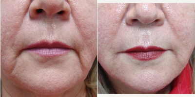 55-64 year old woman treated with Juvederm - 62 year old female 3 weeks after Juvederm Ultra Plus XC to marionette lines. Topical anesthesia used for Med Spa procedure.
