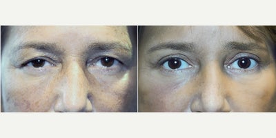 35-44 year old woman treated with Eyelid Retraction Repair - Upper Blepharoplasty Surgery to 39 year old female to improve tired, puffy eyelids.