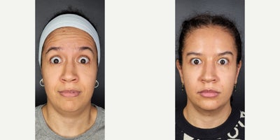 35-44 year old woman treated with Dysport - Botox injection in frontalis, glabella and crow's feet