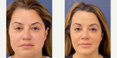 Woman treated with Microneedling, Buccal Fat Removal - New year, a refined you.Facial contouringJawline definitionDeep RF micro-needlingCustom BotoxA curated selection of lasersBuccal fat removal, in-office under local anesthesia