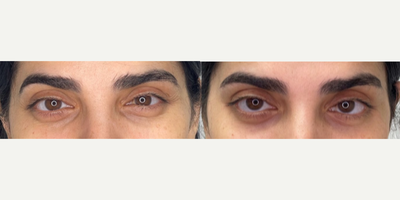 25-34 year old woman treated with Upneeq - Upneeq Treatment done on eyes