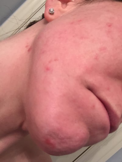 What is this rash under my breast? I am currently on 40mg of accutane and I  do get sweaty in this region. Is it a sweat rash? : r/Dermatology