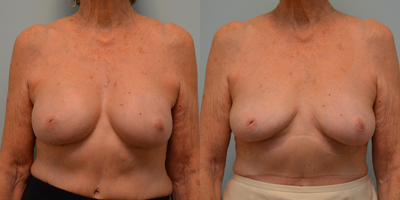 Removal of implants on 75 year old patient following multiple implant-exchange surgeries. - This patient 75 year old patient had undergone an initial breast augmentation in 1988. Over the course of 26 years, she had undergone multiple revision surgeries to try meeting her desired size and to improve symmetry. We discussed her options and goals and she confidently decided on having her implants removed without replacing them. She is seen here 9 months after the removal of her 4 year old, intact saline-implants.