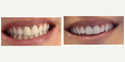 35-44 year old woman treated with Dental Crown - Patient had 2 upper front crowns placed over ten years ago. They had since discolored and the dark metal was showing through at the upper margin. Her tissue was very inflamed from the poor fit. She also wasn't satisfied with the overall color of her smile. Here, we whitening her teeth and replaced her old metal crowns with 2 upper porcelain crowns. In this photo, the tissue is still slightly inflamed but healed up very very nicely about a week later. We try to do metal-free dentistry whenever possible.