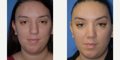 25-34 year old woman treated with Rhinoplasty - Rhinoplasty to create a thinner nose and better profile