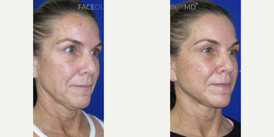 Woman treated with CO2 Laser, Facial, Neck Lift - This patient came to our office seeking facial and skin rejuvenation to reverse signs of aging.To achieve her goals, we performed our signature FaceologyLIFT which was effective in sculpting her jawline, lifting her neck, and tightening her skin. After her procedure, she underwent CO2 Laser Resurfacing to reduce the appearace of sun damage and deep wrinkles while enhancing her overall complexion.