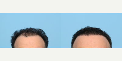 45-54 year old man treated with FUE Hair Transplant, Hair Transplant, Hair Loss Treatment, PRP for Hair Loss, NeoGraft - 54-year-old patient had concerns with thinning hair in the front to middle of scalp. Dr. Wise performed an FUE hair transplant where he transplanted 3,010 grafts into zones 1 and 2. On the same day as his procedure the patient also underwent PRP therapy to strengthen the follicles and assist with faster healing. 6 months post-op and is very happy with the results!