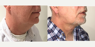 35-44 year old man treated with Neck Lift - 44 Year old male underwent cervical spanning suture, photos 2 months post op