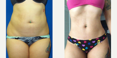 Woman treated with Liposculpture - Woman treated with Liposculpture