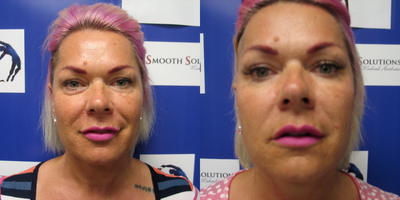 35-44 year old woman treated with Thread Lift - Medi thread lift to lower face. See how the nasolabial folds are lifted.