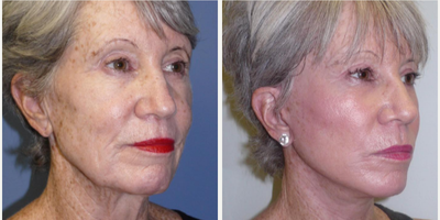 Woman treated with Neck Lift - Woman treated with Facelift, Neck Lift, Facial Fat Transfer,and CO2 Laser Resurfacing.
