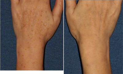25-34 year old woman treated with PicoWay - Before and After photo of right hand of patient using Picoway to remove brown spots
