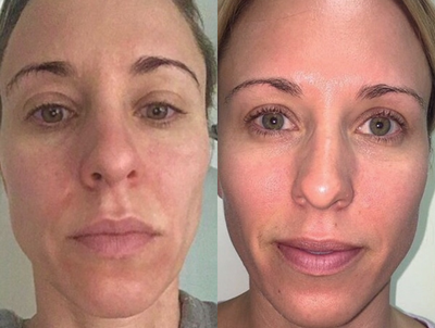 35-44 year old woman treated with Vivace - Due to a lot of running and working out, this patient began losing volume in her face. Rather than using fillers, this patient wanted a more natural enhancement to add more volume to her face. With only three Vivace treatments, our patient has stimulated her own collagen production and achieved her goal of adding more volume to her face.