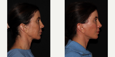 45-54 year old woman treated with Facelift - 1 month post op