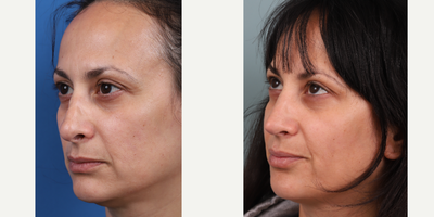 35-44 year old woman treated with Revision Rhinoplasty, Asian Rhinoplasty - Revision rhinoplasty with rib cartilage graft