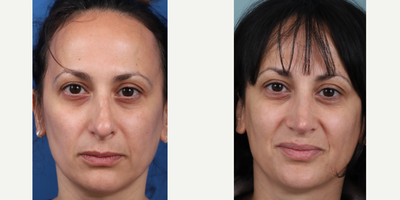35-44 year old woman treated with Revision Rhinoplasty, Asian Rhinoplasty - Revision rhinoplasty with rib cartilage graft