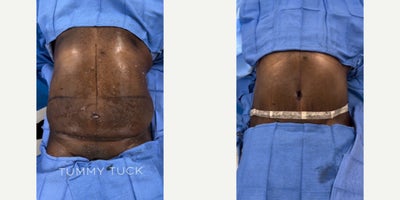 Man in his mid 50s treated with Tummy Tuck - Man in his mid 50s treated with Tummy Tuck. Patient lost 75 lbs (max: 285 lbs, current: 210 lbs) prior to his surgery.