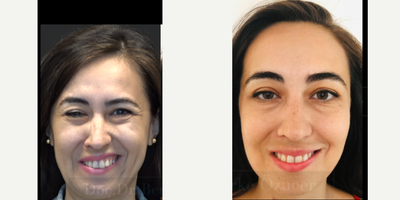 35-44 year old woman treated with Facial Reconstructive Surgery - facial paralysis and synkinesisselective neurolysis (selective neurectomy) surgery was carried out for smile reanimation and unwanted closure of eye and neck tightness