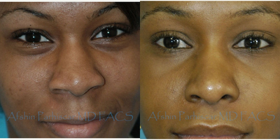 18-24 year old woman treated with African American Rhinoplasty - 22 year old female wanted a more shapely nose that had more definition. She wanted her nose to look natural and fit her face. She had a rhinoplasty.