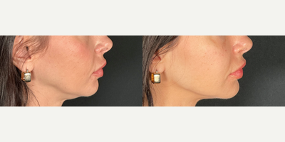 35-44 year old woman treated with Chin Filler - Non surgical jawline and chin enhancement using Juvederm Volux, to restore youthful contours to the jawline and a better defined chin.