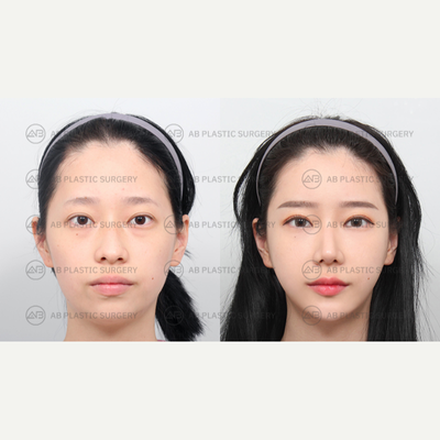 18-24 year old woman treated with Genioplasty, Cheekbone Reduction, Jaw Reduction, Facial Fat Transfer, Rhinoplasty, Eyelid Surg - By: Dr. Ahn Seung Hyun, Dr. Bae In Ho, Dr. Kim Joo Yeon