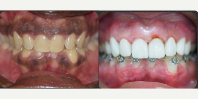 Man treated with Porcelain Veneers, Teeth Whitening, Braces - Man treated with Porcelain Veneers, Teeth Whitening, Braces