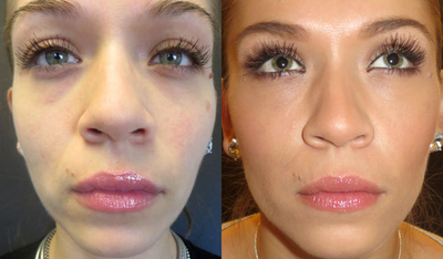 32 year-old female before and after 2 syringes of Belotero - 32 year-old female before and after  2 syringes of Belotero