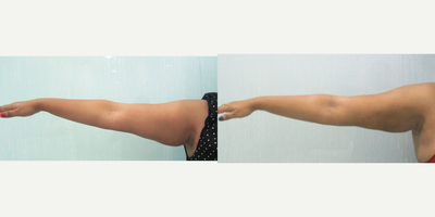 18-24 year old woman treated with Exilis - A 23-year-old female complains of saggy arms. Exilis was done to tighten the saggy arms.