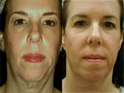 Affirm CO2 Laser - 
	It utilizes an innovative fractional CO2 laser which creates tiny microscopic channels in the tissue so that new collagen can grow in to rejuvenate the skin. It dramatically reduces the appearance wrinkles while tightening the skin.
